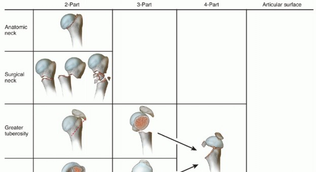 Illustration of surgical neck fracture - Dr. Mohammed Hutaif