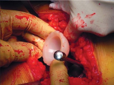 صورة طبية: تقنية الجذع القصير لاستبدال مفصل الورك الكلي: نهج الأستاذ الدكتور محمد هطيف لتدخل جراحي أقل ونتائج أفضل