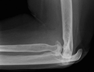 Illustration 28 for Master Diagnosis: Shoulder & Elbow Cases (Reproduced with Permission)