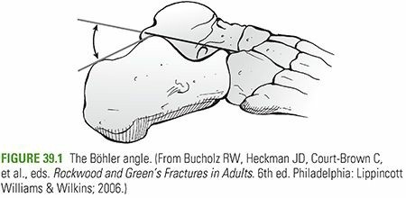 Calcaneus Fractures: Essential Insights into Your Heel Bone