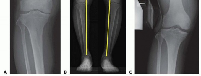 Illustration 2 for High Tibial Osteotomy: Realignment for Lasting Knee Pain Relief