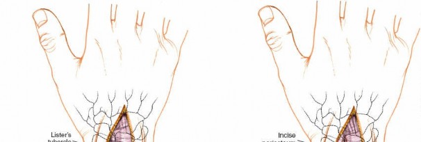 Illustration 15 for Essential Surgical Approaches: Uncover Every Aspect of the Wrist