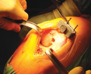 Illustration 14 for Cemented TKA Figure: Your Visual Guide to Surgical Success