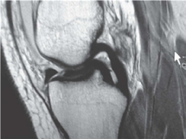 Illustration 2 for Knee Exam Prep: Meniscus Basic Science Questions to Master