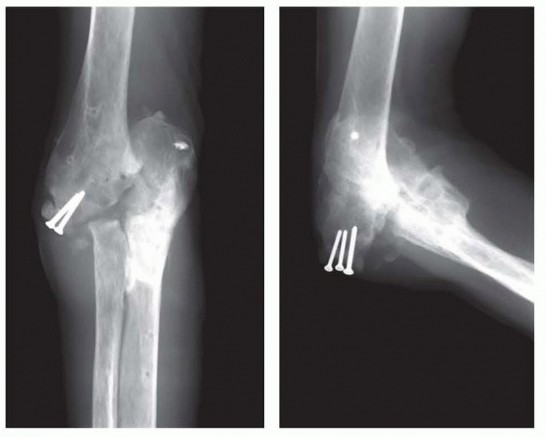 Surgical Management of Traumatic Conditions of the Elbow: Interposition Arthroplasty