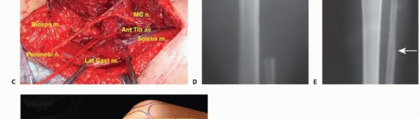 صورة طبية: استئصال أورام الشظية: دليل شامل للعلاج الحديث والحفاظ على الأطراف مع الأستاذ الدكتور محمد هطيف