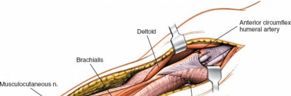 Illustration 11 for Humeral Shaft Anterior Approach: Master Surgical Techniques