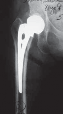 Hemiarthroplasty: Get the b tech fig on Hip Implant Types