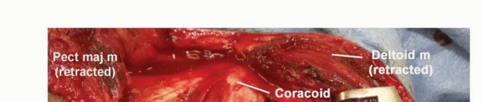 صورة طبية: استئصال أورام الكتف مع الحفاظ على الطرف: أحدث التقنيات لنتائج مثالية مع الأستاذ الدكتور محمد هطيف