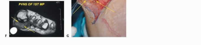 صورة طبية: أورام القدم: دليلك الشامل للعلاج، البتر، والاستئصال مع الأستاذ الدكتور محمد هطيف في صنعاء