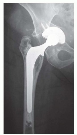 Revision Arthroplasty with Acetabular Bone Loss: The Antiprotrusio Cage