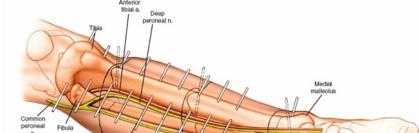 Illustration 32 for Expert Guide: Ulna and Wrist External Fixation Pin Placement