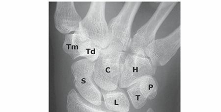 Decoding Wrist Fractures: Essential Facts on Fractures of the Body