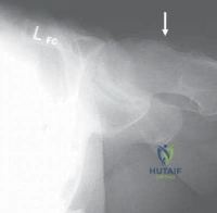 Identification of the Gluteus Medius Interval