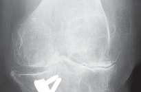 Optimize Tibial Component Alignment: Techniques for TKA Success