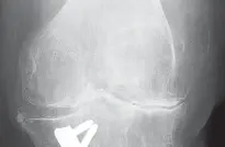 صورة توضيحية لـ محاذاة مكونات عظم الساق في جراحة استبدال الركبة الكلي: دليل شامل لتحقيق أفضل النتائج مع الأستاذ الدكتور محمد هطيف في صنعاء