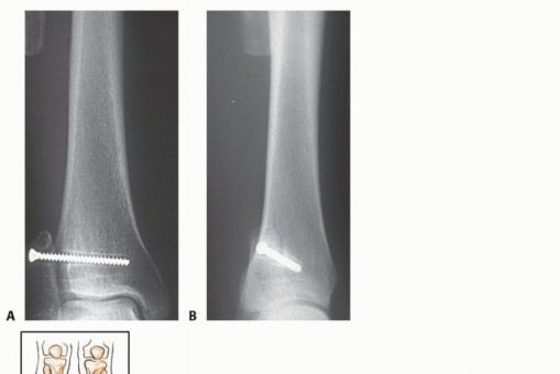 صورة توضيحية لإجراء الخزعة العظمية
