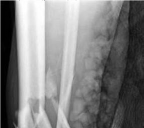 Illustration of plating and screws - Dr. Mohammed Hutaif