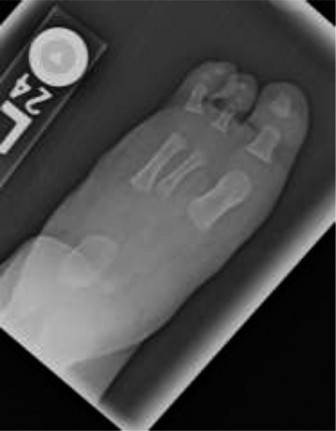 Fibular Deficiency: Understanding Absence of Lateral Rays in Kids