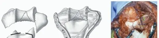 Illustration of class ii ho - Dr. Mohammed Hutaif