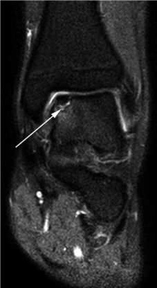 Illustration 30 for First Metatarsal Surgery: Expert Solutions for Foot & Ankle Pain