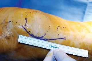 Illustration 19 for Unicompartmental Knee Arthroplasty: Master decisions with this b c figure guide.