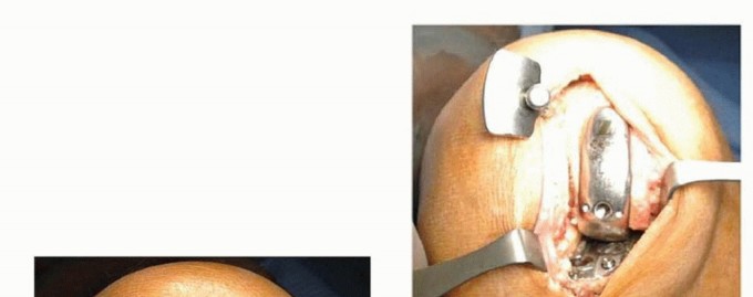 Illustration 15 for Unicondylar Knee Arthroplasty: Is This Your Solution to Knee Pain?