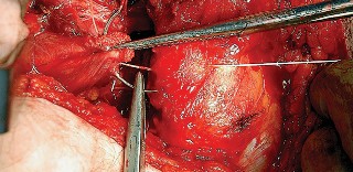 Illustration 73 for Unlock the Figure Posterior Approach to the Hip