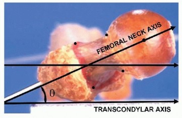 Femoral Rotational Osteotomy: Proximal & Distal Guide, courtesy of childrens
