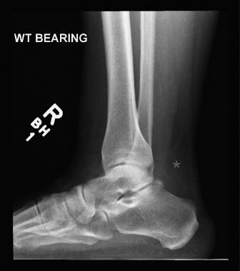 Achilles Tendon Rupture: Comprehensive Guide to Epidemiology, Anatomy, Biomechanics, and the Critical Watershed Zone