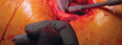 صورة طبية: تقنية الجذع القصير لاستبدال مفصل الورك الكلي: نهج الأستاذ الدكتور محمد هطيف لتدخل جراحي أقل ونتائج أفضل