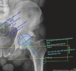 Illustration 5 for Patient Case: Resurfacing Primary Hip Arthroplasty for Lasting Relief