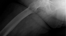 Illustration 15 for Mastering Direct Anterior Approach Hip Arthroplasty Without a Traction Table