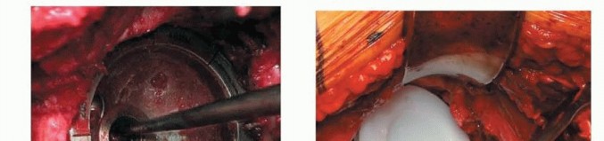 Illustration 10 for Uncemented THA: Critical Soft Tissue Tension for Joint Stability