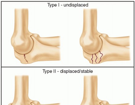 Mastering Proximal Ulna Fractures & Dislocation of the Radial