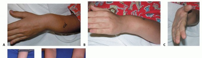 Illustration of radial head dislocation - Dr. Mohammed Hutaif