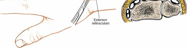 Illustration 21 for Dorsal Wrist Approach: Expert Access to the Column of the Distal Radius