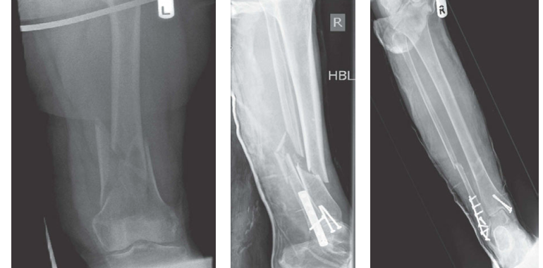 Tackle a Complex Lower Limb Trauma Examination Question