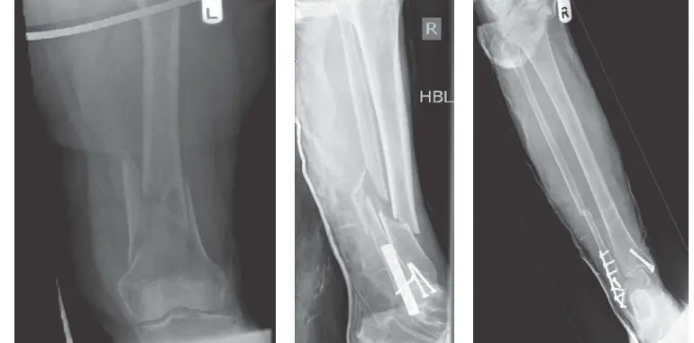 صورة توضيحية لـ علاج كسور الأطراف السفلية المعقدة في صنعاء مع الأستاذ الدكتور محمد هطيف
