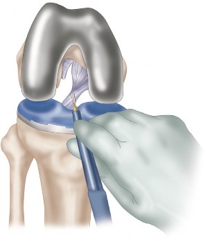 Illustration 11 for Posterior Cruciate Ligament-Retaining TKA: Navigating Pitfalls