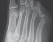 Illustration of fixation of jones - Dr. Mohammed Hutaif