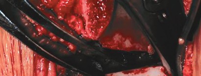 Illustration 49 for Bernese PAO: Unlocking the Procedure with Level V Evidence Insights