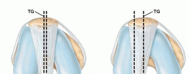 Relieve Knee Pain & Instability with Tibial Tubercle Transfer