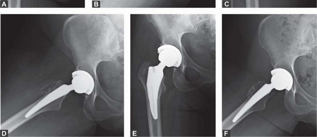 صورة طبية: تقنية الجذع القصير لاستبدال مفصل الورك الكلي: نهج الأستاذ الدكتور محمد هطيف لتدخل جراحي أقل ونتائج أفضل
