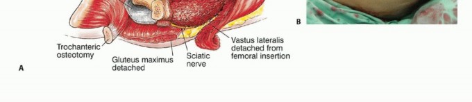 Illustration 24 for Beyond Amputation: Total Femur Resection with Endoprosthetics
