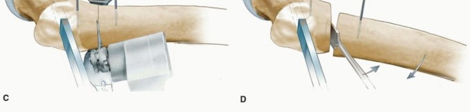 Illustration 33 for Periacetabular Osteotomy: Realigning your hip via the superior pubic ramus