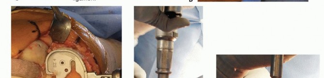 Illustration 19 for Achieve Lasting Pain Relief with Cemented Total Knee Arthroplasty