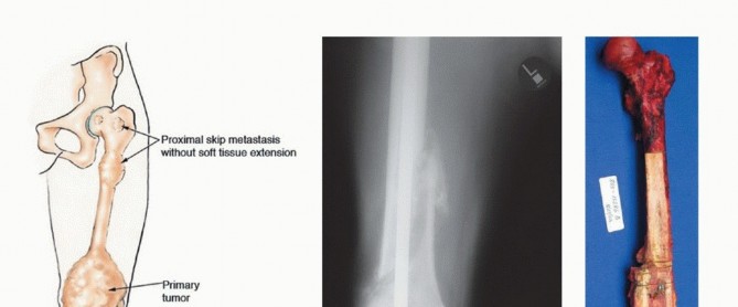 Mastering Hip Disarticulation: Through the Hip Joint Capsule