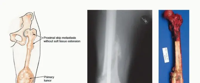 صورة توضيحية لـ استئصال مفصل الورك: دليل شامل للمرضى مع الأستاذ الدكتور محمد هطيف