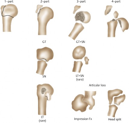 Mastering Proximal Humeral Fractures: Key Insights & Treatment